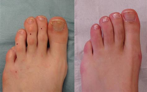 Little toe surgery! (Before and after) 